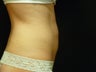 CoolSculpting