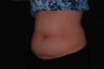 CoolSculpting on belly