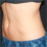 CoolSculpting