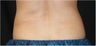 CoolSculpting