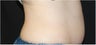 CoolSculpting
