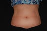 CoolSculpting