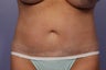 CoolSculpting