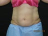CoolSculpting