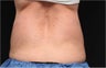 CoolSculpting