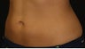 CoolSculpting