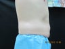 CoolSculpting