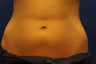 CoolSculpting