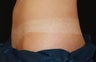 CoolSculpting - FreezeThisFat