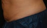 CoolSculpting - FreezeThisFat