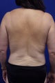 Zeltiq CoolSculpting