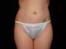 Cool Sculpting on Upper and Lower Abdomen