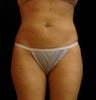 Cool Sculpting on Mid Abdomen