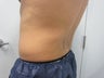 CoolSculpting