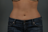 Liposuction of the Abdomen
