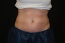 Coolsculpting - Non Invassive Fat Reduction