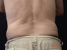 Coolsculpting