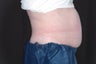 Zeltiq - Non Invasive Fat Reduction in Abdomen - 1 treatment
