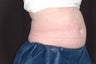 Zetiq Precedure for Abdomen