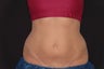 Coolsculpting by Zeltiq to Lower Abs and Love Handles