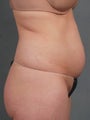 CoolSculpting