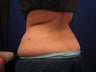 CoolSculpting