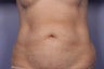 Zeltiq CoolSculpitng to Abdomen