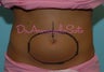 Coolsculpting by Zeltiq