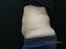 CoolSculpting
