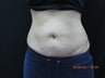 CoolSculpting