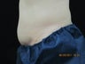 CoolSculpting