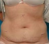 Coolsculpting