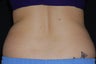 CoolSculpting