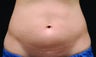 Body contouring