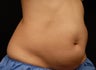 Body contouring