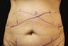 CoolSculpting by zeltiq