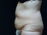 CoolSculpting