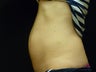 CoolSculpting