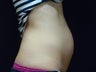 CoolSculpting