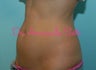 Coolsculpting by Zeltiq