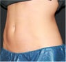 CoolSculpting