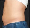 CoolSculpting