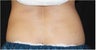 CoolSculpting