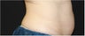 CoolSculpting