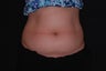 CoolSculpting