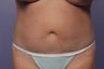 CoolSculpting