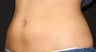 CoolSculpting
