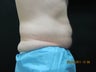CoolSculpting