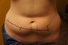 CoolSculpting