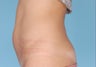CoolSculpting